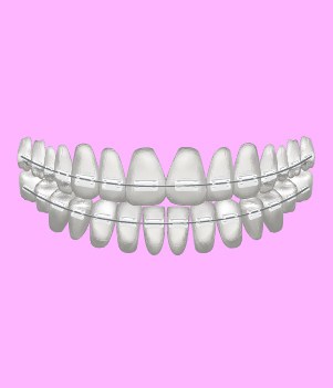 Ceramic Braces