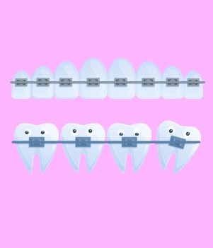 Traditional Braces