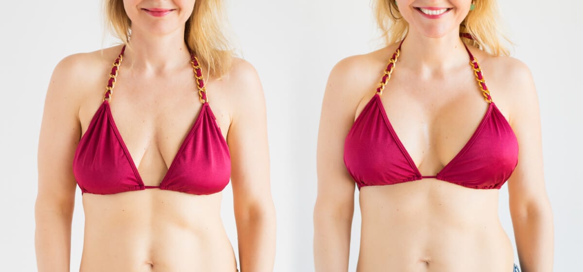 breast lift before and after