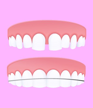 dental braces